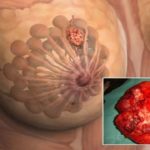 Most Women Drink This Beverage Every Day Without Doubting it Can Lead to Breast Cancer