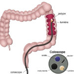 The Socking Truth About Colonoscopy That Your Doctor Will Never Let You Know