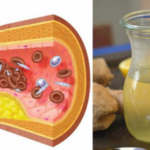 Stop Wasting Your Money on Pills for High Blood Pressure and Cholesterol. Try this Remedy for a Week and your Problem Will Be Solved!