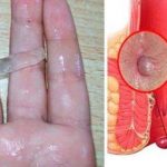 DIY Natural Cure For Hemorrhoids, You Will Be Surprised